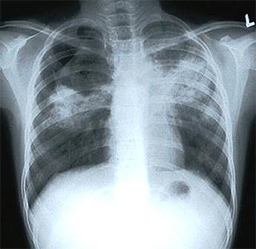 tuberkuloza.jpg